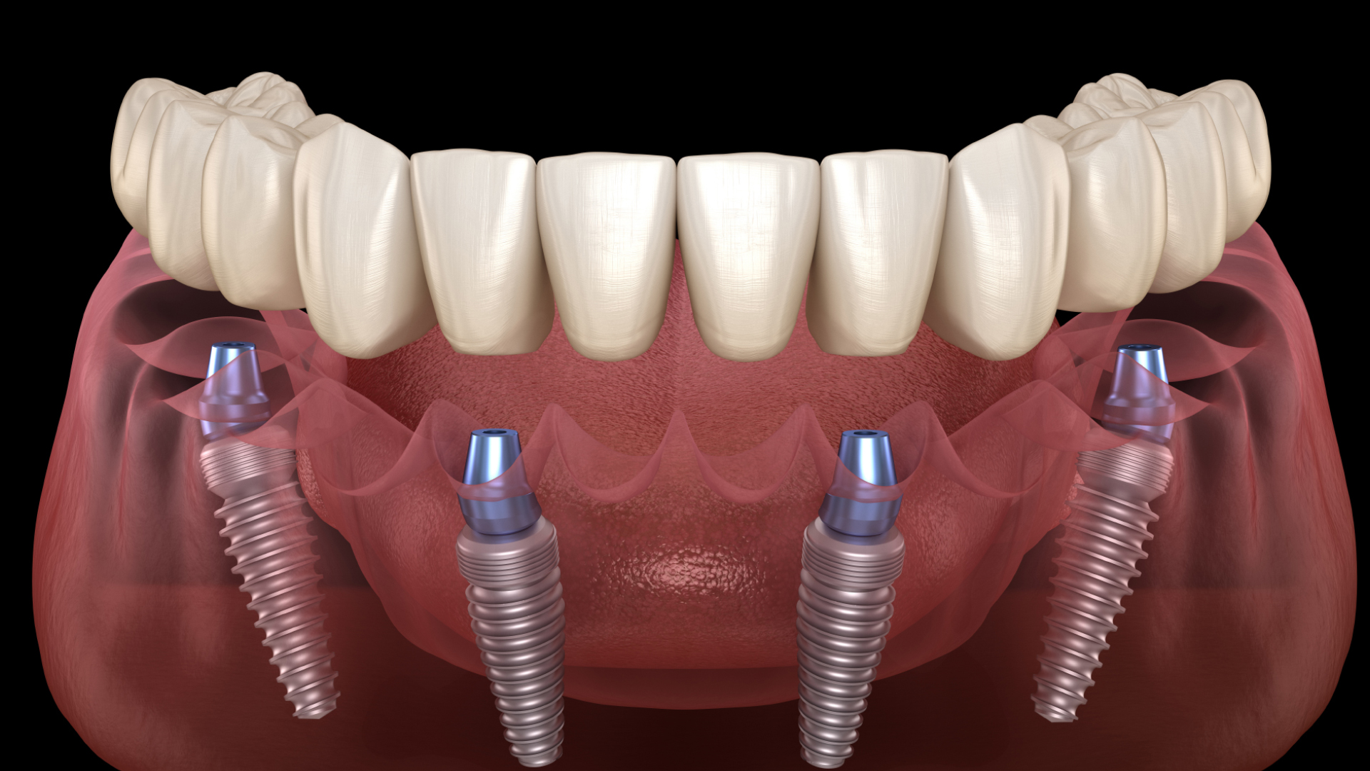 3D illustration of a full lower arch dental implant supported bridge
