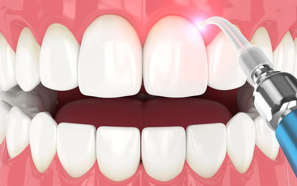 A 3D rendering of healthy teeth and gums, with a laser device treating a front tooth