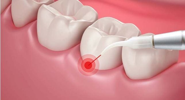 3D illustration of laser gum treatment targeting an inflamed area