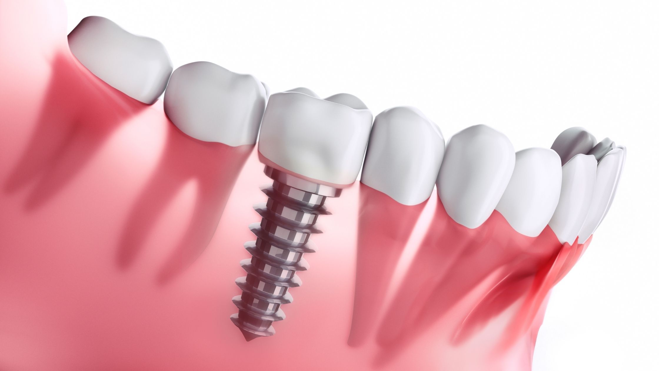 3D illustration of a single dental implant integrated into the jawbone