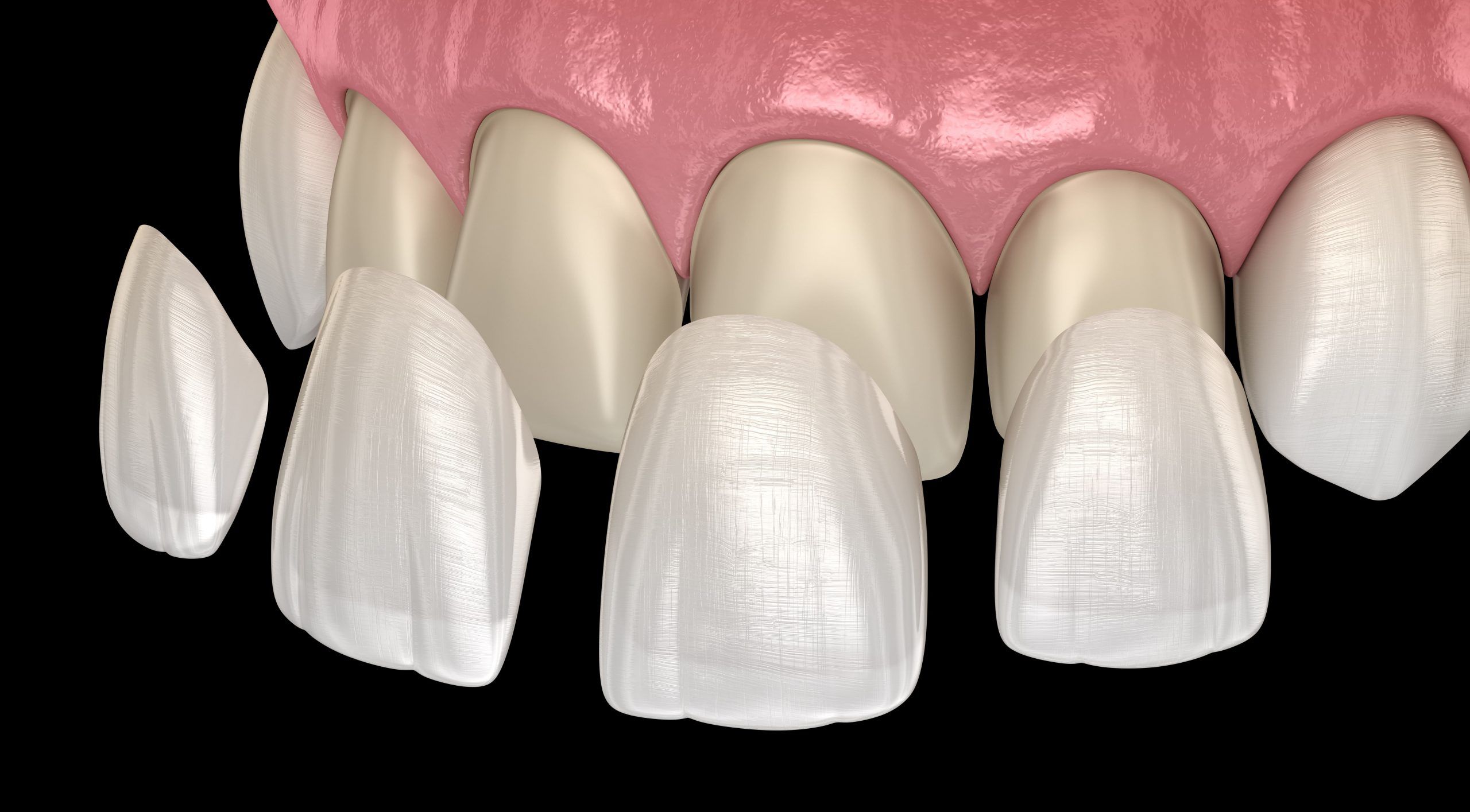 Dental illustration showing porcelain veneers being applied to teeth