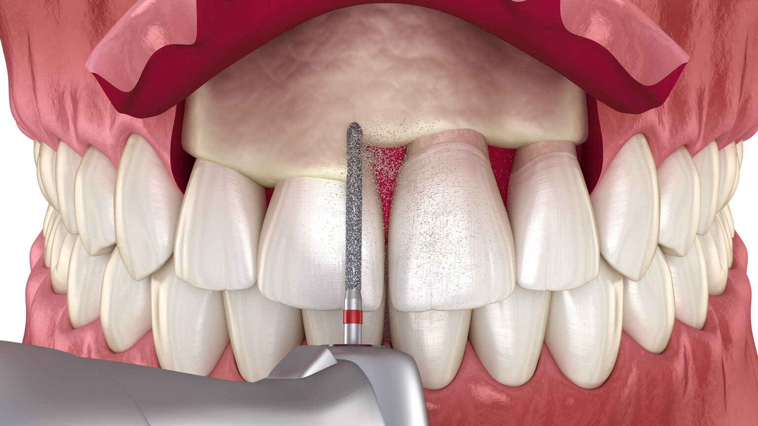 Can Tooth Rot Under Crown Nina Mickens Hochzeitstorte