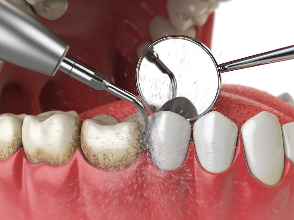 3D illustration of dental scaling and cleaning procedure on a tooth with plaque