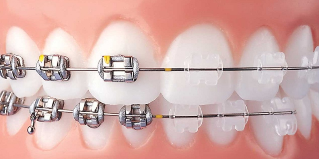 Close-up of teeth with both metal and clear ceramic braces