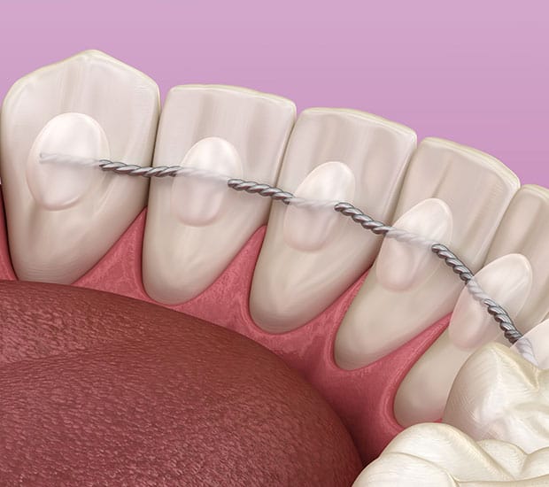 A 3D rendering of lower teeth with a lingual retainer and clear attachments