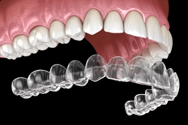 A 3D rendering shows an upper set of healthy teeth and gums, with a clear aligner for the lower teeth floating below them