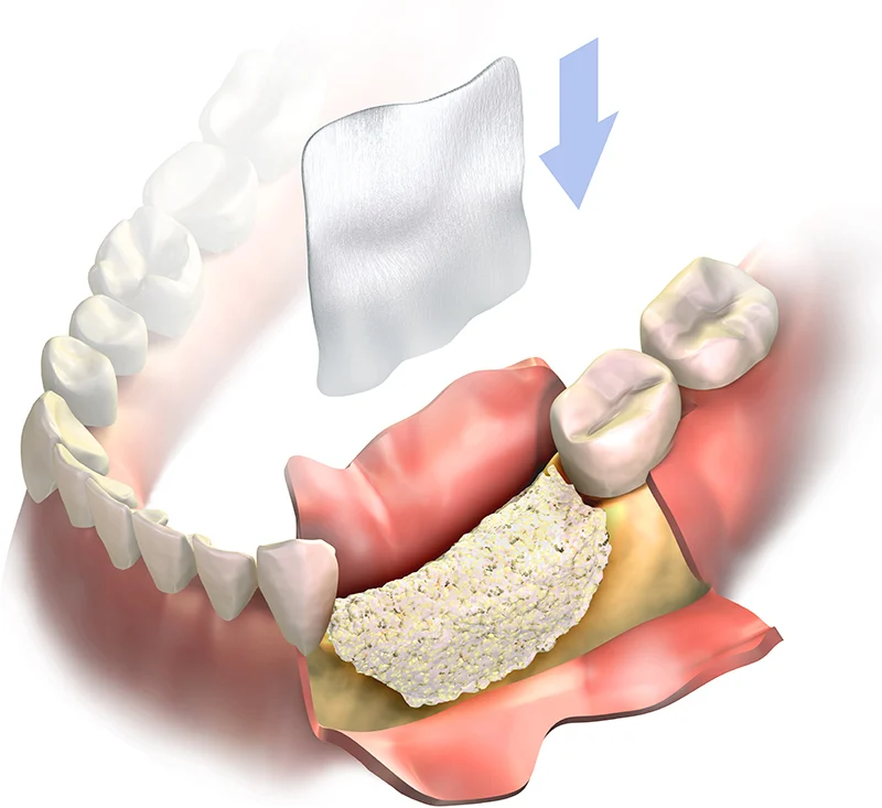 3D illustration showing guided bone regeneration with a membrane over bone graft