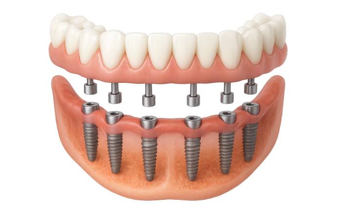 All on 6 dental implants in nyc