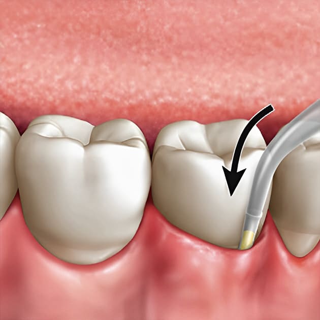 3D illustration of dental deep cleaning with an arrow showing probe direction
