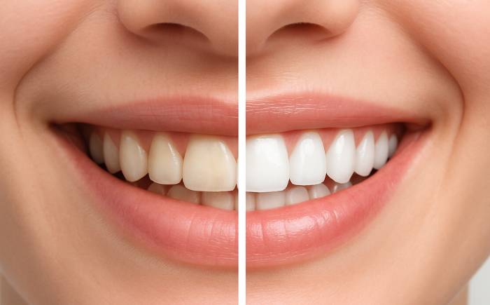 Before after comparison of teeth cleaning