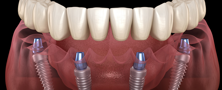 All-on-4 implants