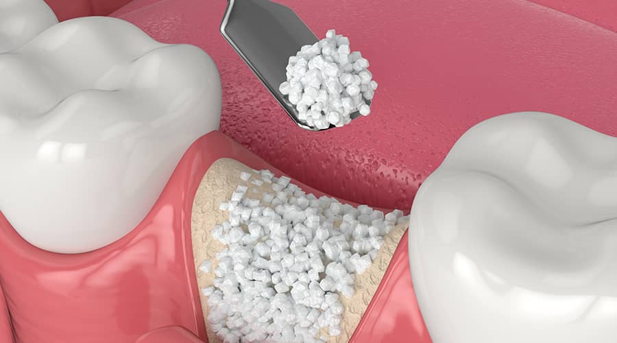 3D illustration of bone grafting material being added to a jawbone