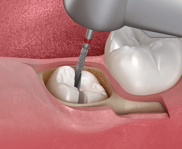 3D illustration of a tooth extraction using a dental drill