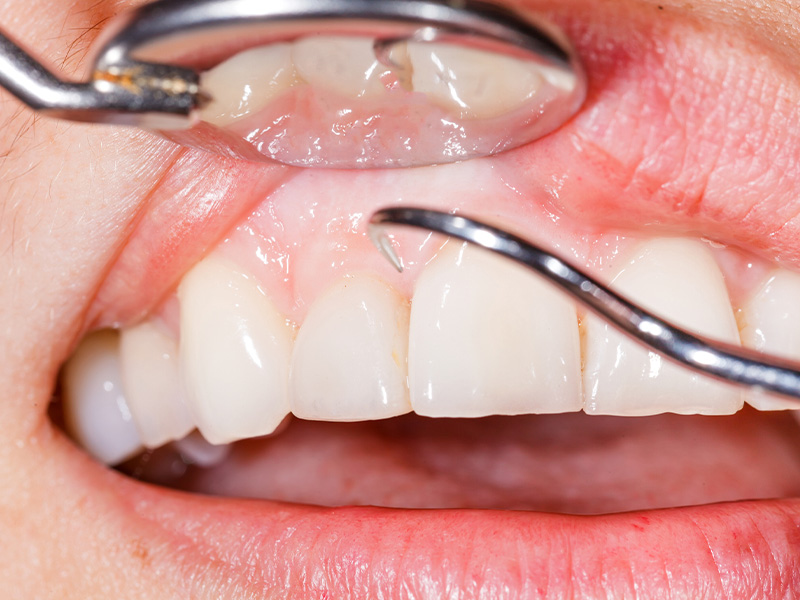 Gloved hands demonstrate a dental implant model using a specialized tool
