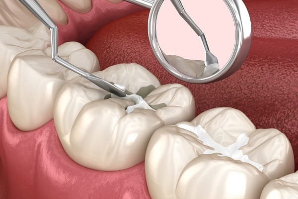3D illustration of a dental filling procedure on a molar