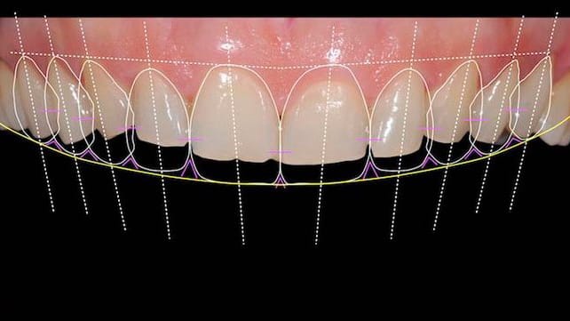 Digital dental smile design overlayed on a patient's upper teeth