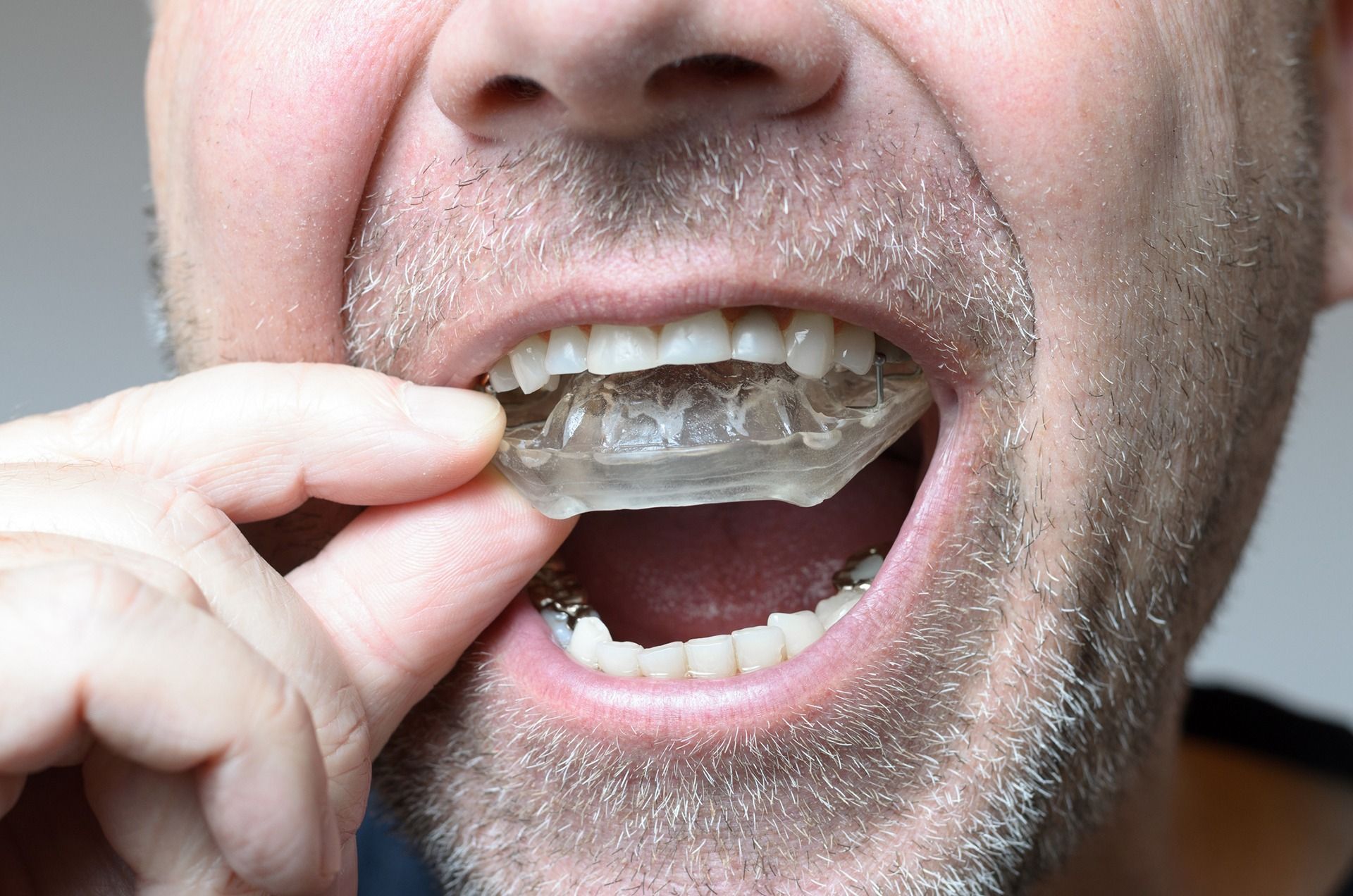 Close-up of a person inserting a clear dental aligner into their mouth