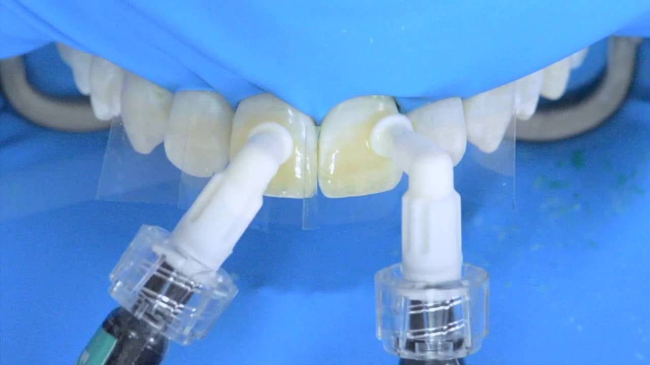 Close-up of teeth being treated with a dental dam and two applicators