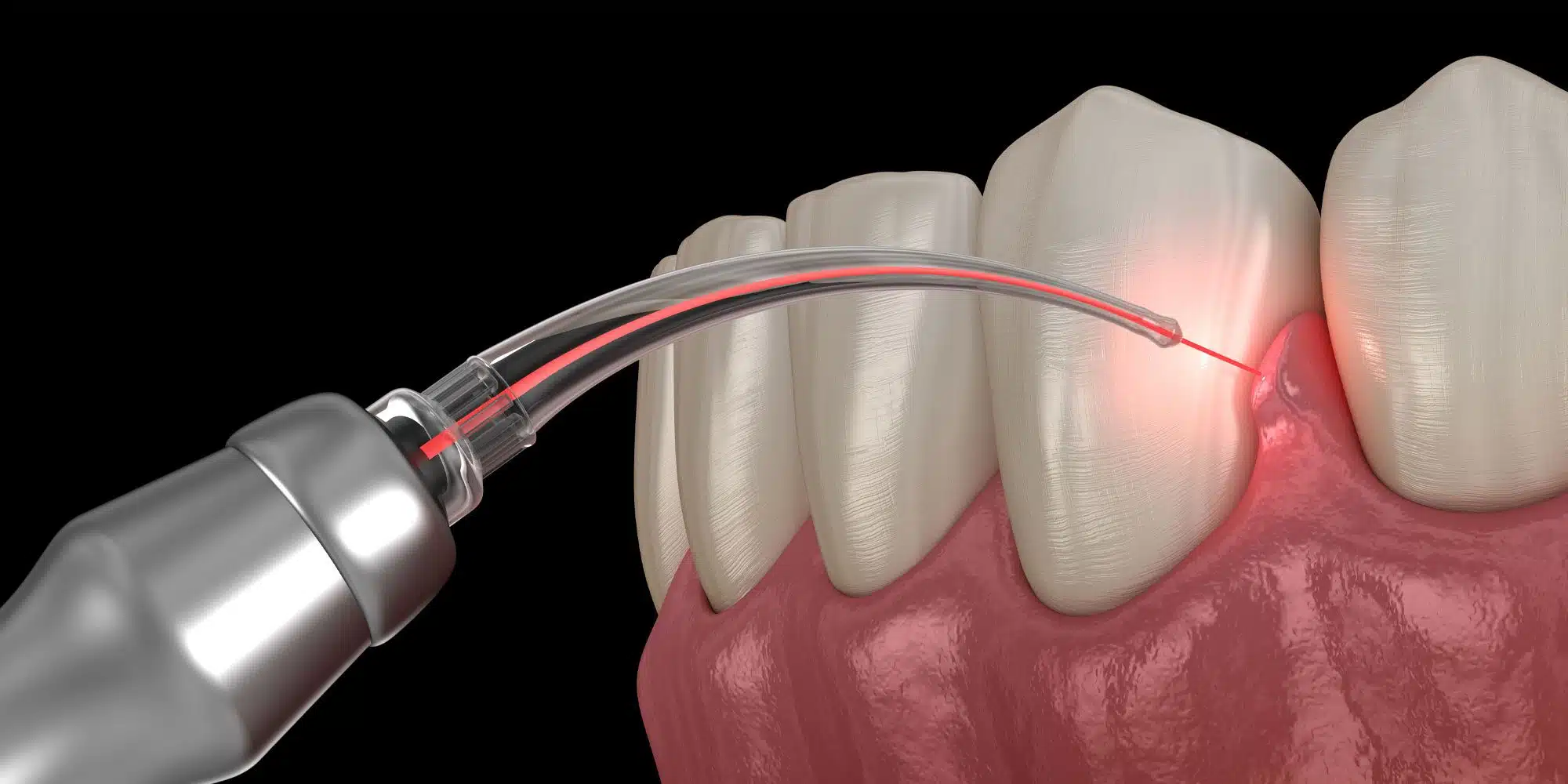 3D illustration of a dental laser treating a gum area with a red light