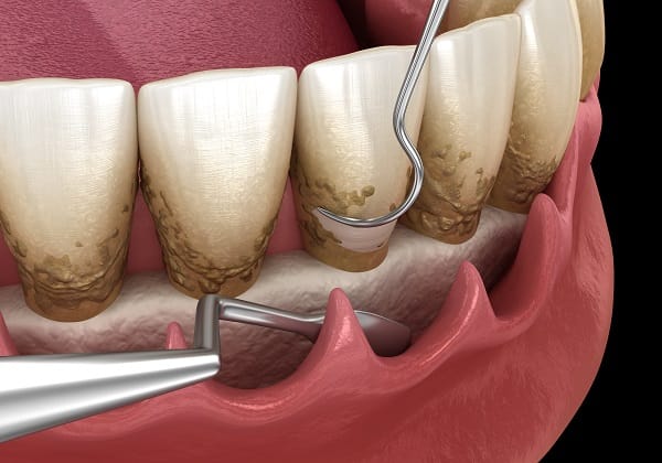 3D illustration showing a dental cleaning tool removing calculus from teeth