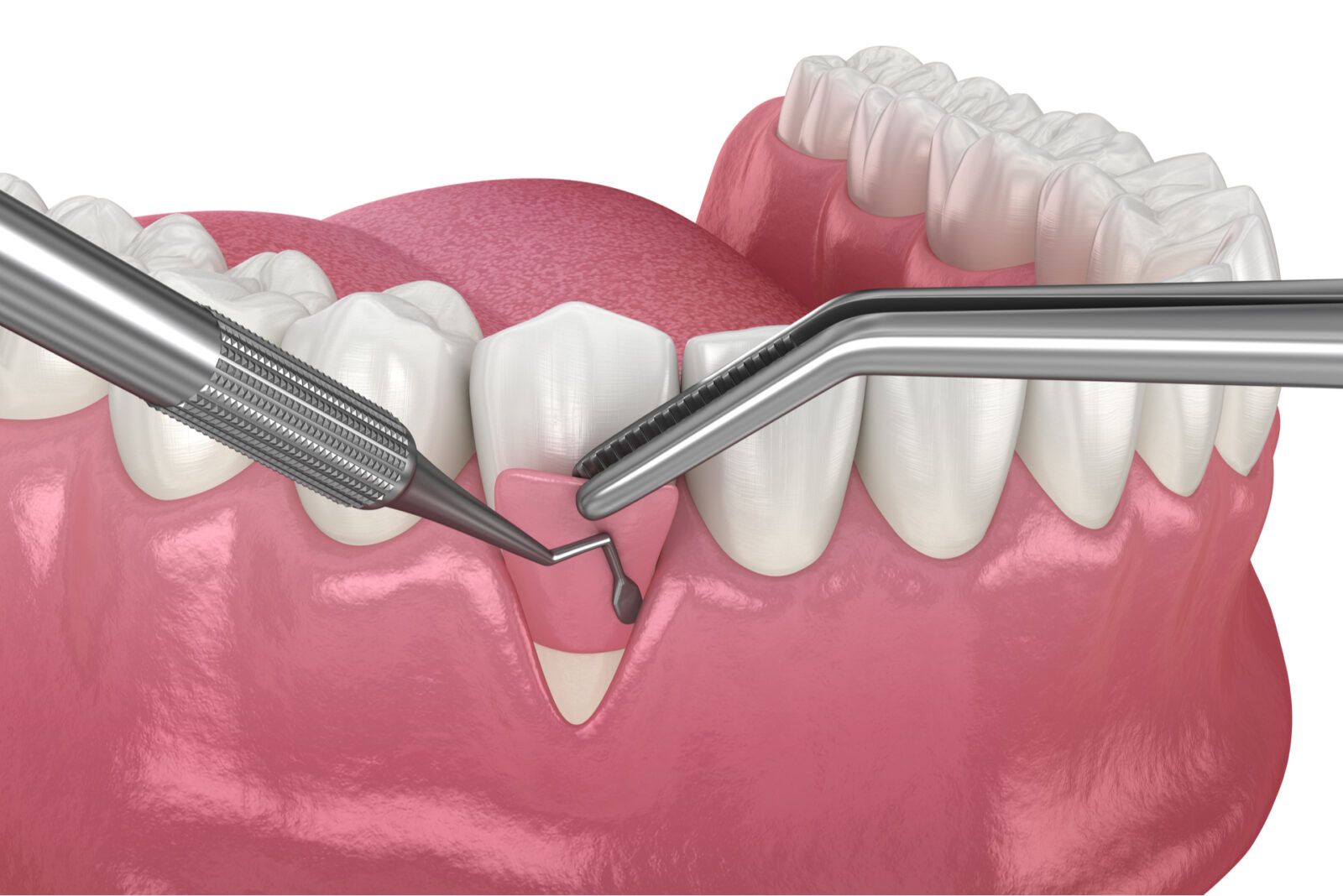 3D illustration of a gum grafting procedure using dental tools