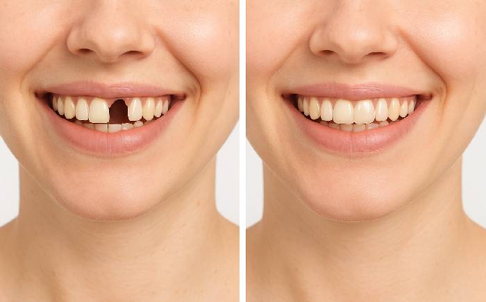 Same Day Dental Implants in NYC: Pros, Cons & Cost