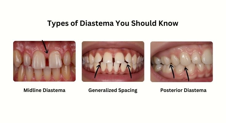 Types of diastema