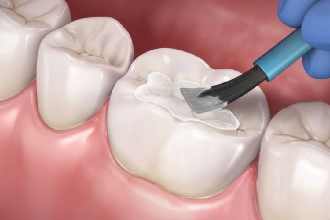 Dental sealants for kids