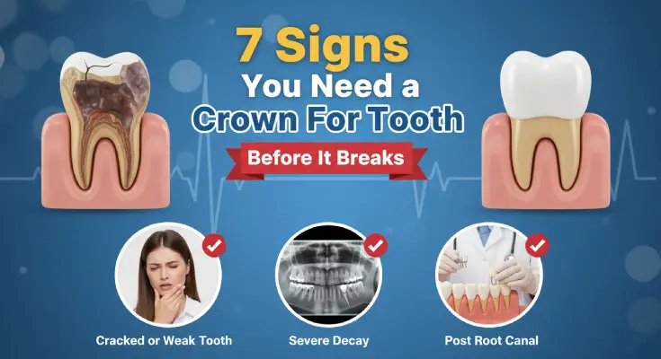 When Do You Need a Dental Crown? 7 Signs It’s Time