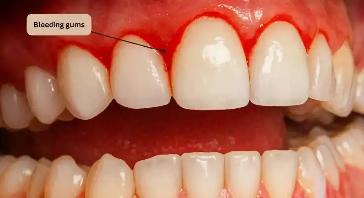 9 Causes of Bleeding Gums (Besides Gum Disease)