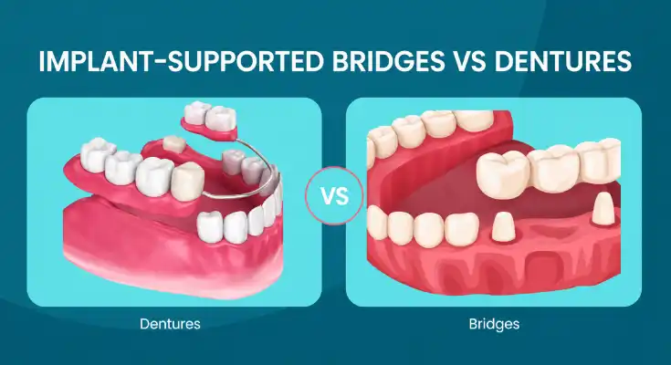 Implant-Supported Bridges vs Dentures: Which is Better?