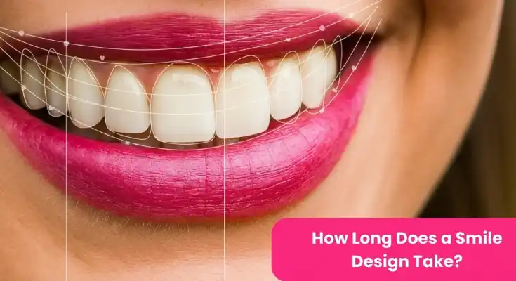 How Long Does a Smile Design Take?