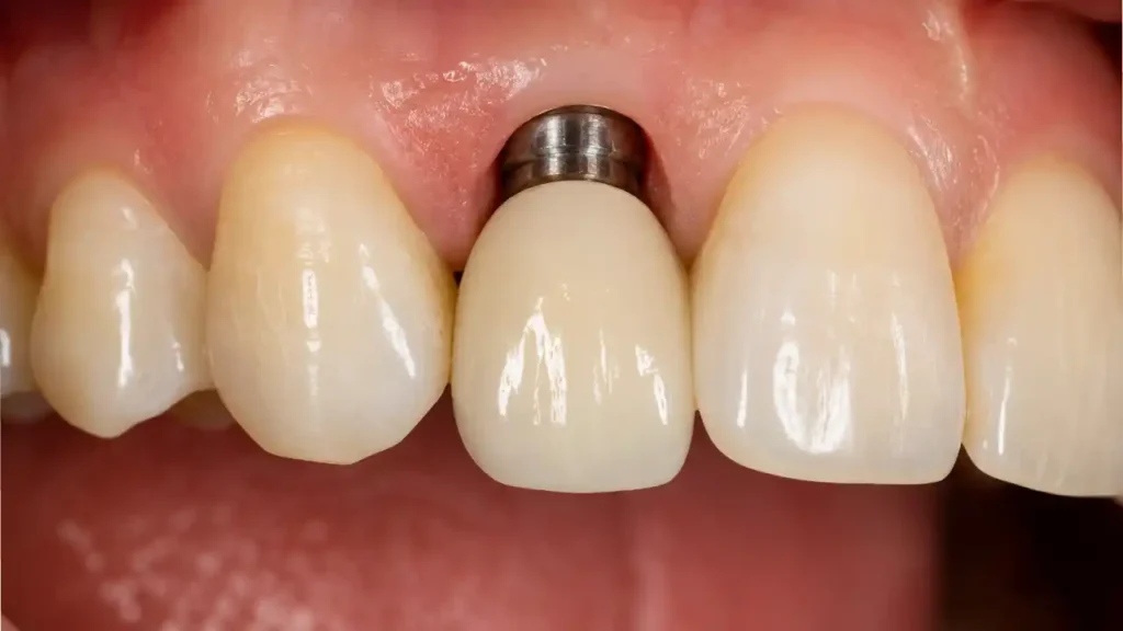 Dental implant replacing a missing tooth in the upper jaw with a natural-looking crown
