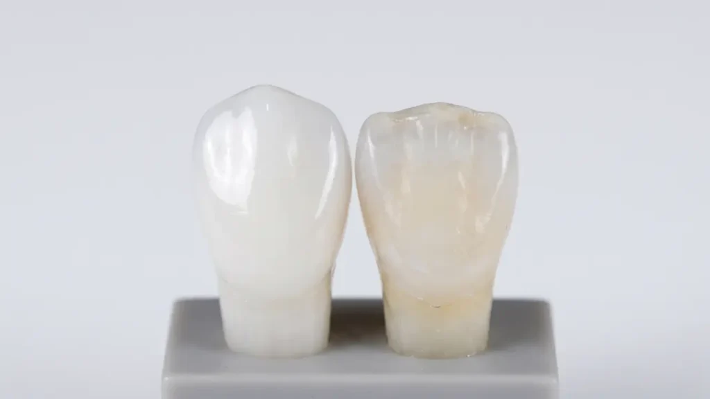 Comparison of healthy tooth enamel versus eroded enamel showing the risk of overusing whitening products