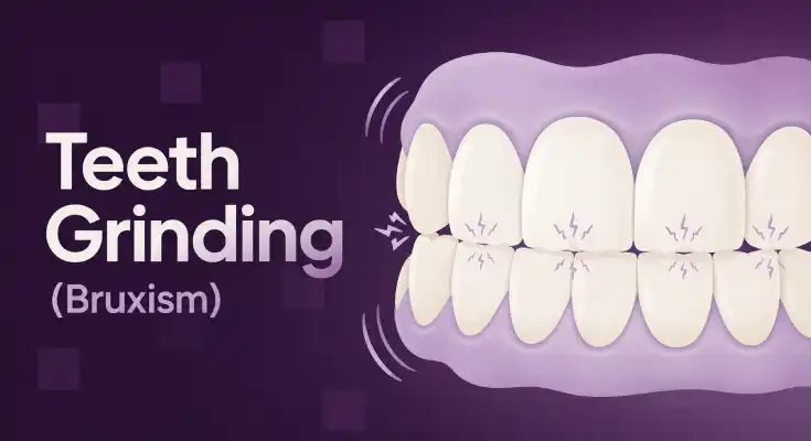 Teeth Grinding (Bruxism): Causes, Effects & Treatment Solutions