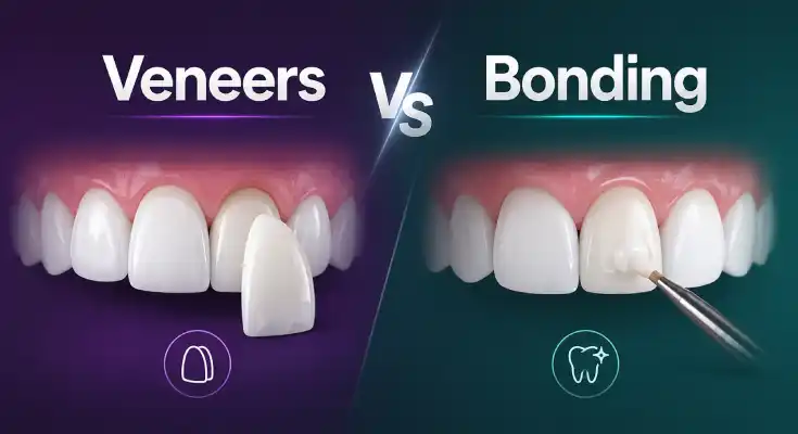Veneers vs Bonding in NYC: Which One Is Right for You?