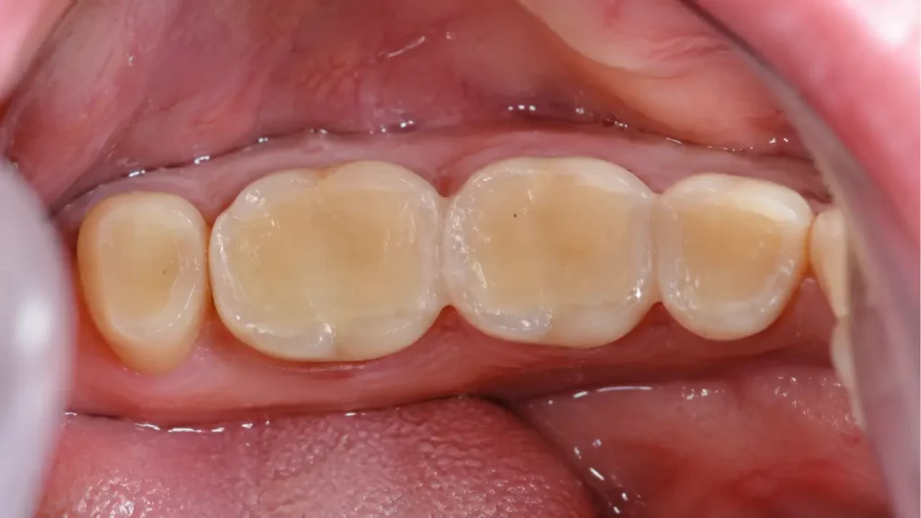 Close-up of worn and flattened teeth caused by bruxism teeth grinding, showing enamel erosion on molars as seen at Al Dental Studio NYC