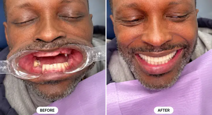 Before and After: A Patient’s Smile Makeover Journey at AL Dental Studio